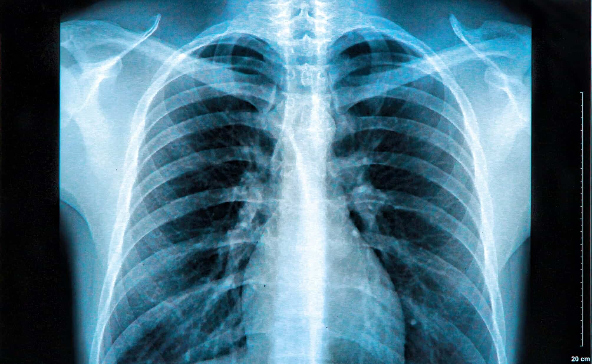 aycan clinical solutions chest x-ray