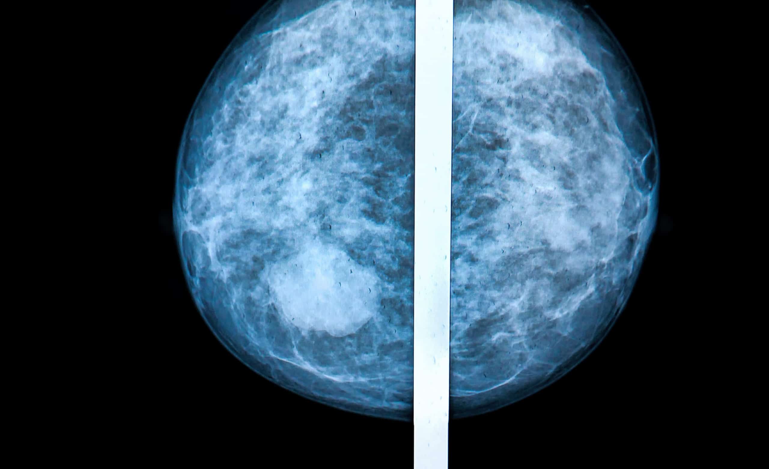 aycan clinical solutions Mammography
