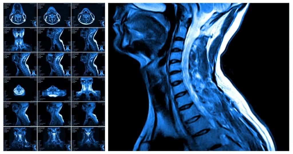 aycan MRI of cervical spine